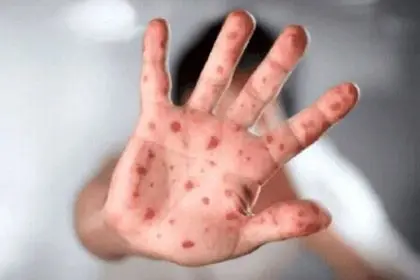 First Suspected Case of Monkeypox in Northern Country