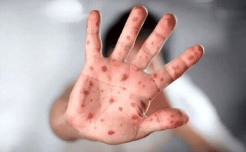 First Suspected Case of Monkeypox in the North of the Country