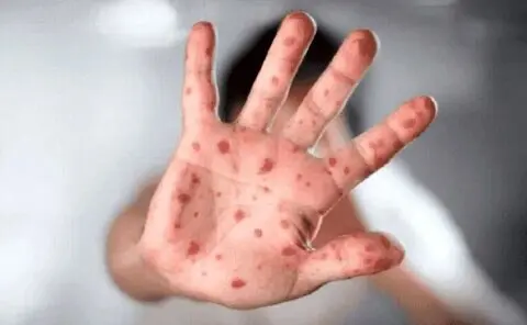 First Suspected Case of Monkeypox in Northern Country