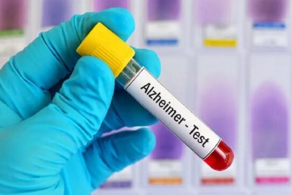 Diagnosing Alzheimer's made possible with blood test