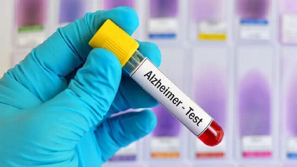 Diagnosing Alzheimer's made possible with blood test